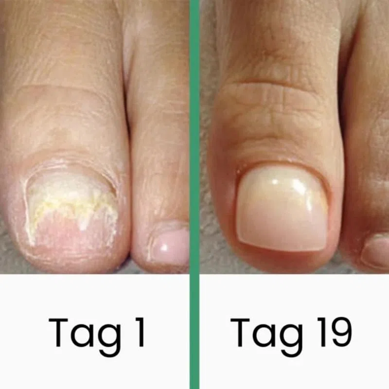 Podomax PODOclip® | LLLT-Nagelpilztherapie(1 Stück)