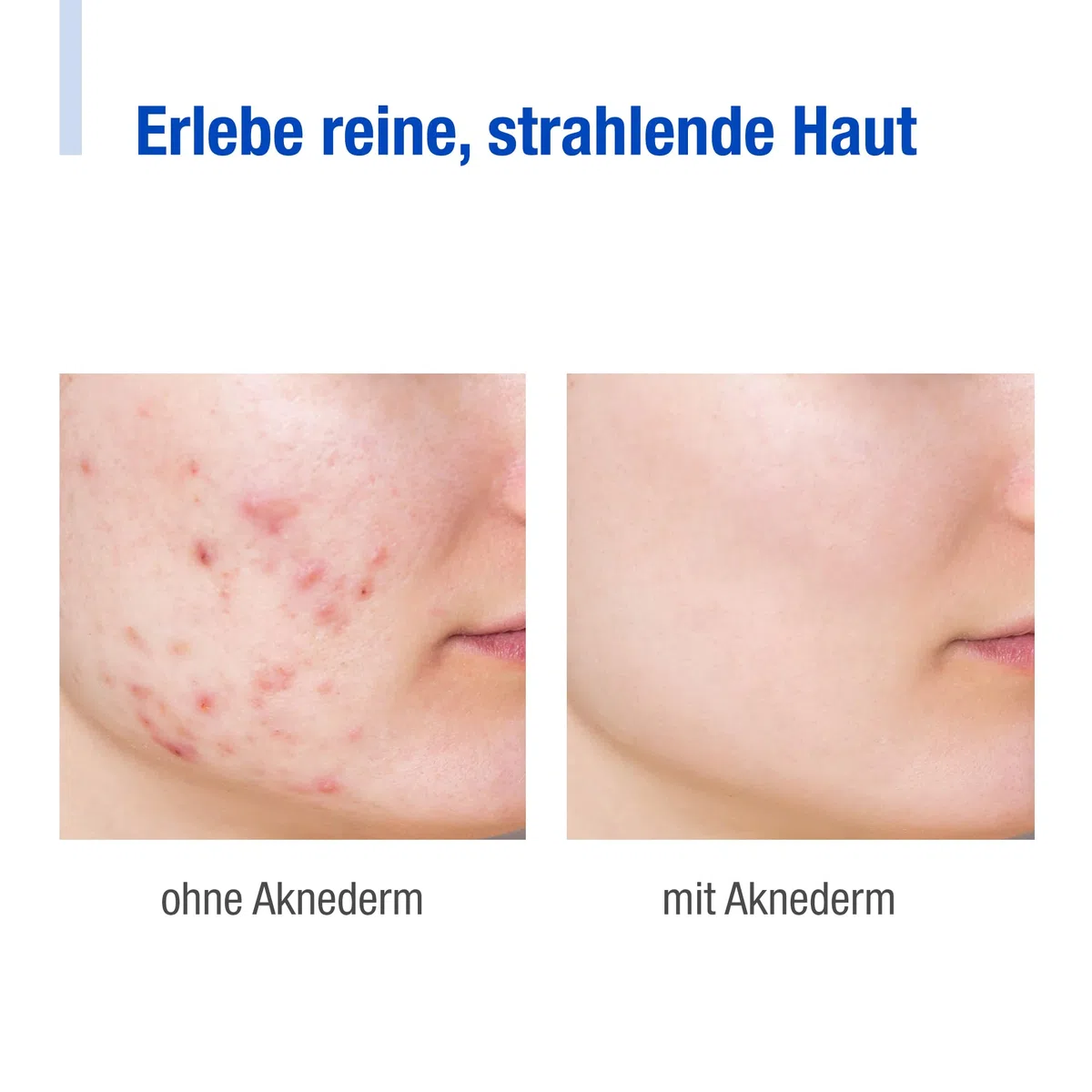 aknederm Premium Set intens für sensible Haut - Set mit Tinktur sensitiv/Reinigungsschaum/Lotion F/Creme intens & Reinigungspads - natürliches Skincare Set - ideal zur Akne Behandlung 230ml