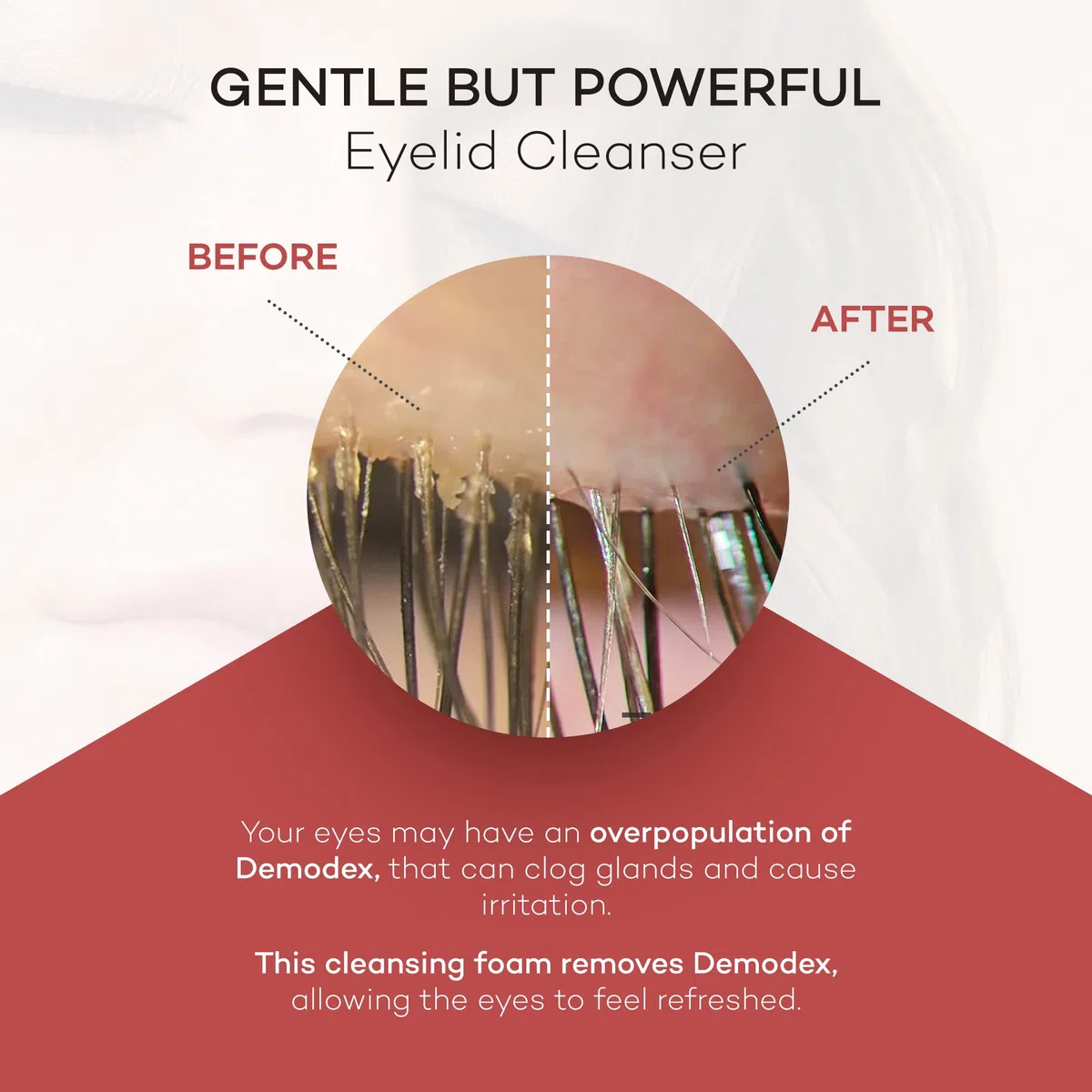 Zocular ZocuFoam Eyelid Cleanser - Foaming Eyelid Scrub for Blepharitis, Demodex and Inflammation - Stye Treatment for Eyes - Natural pH Balanced Treatment - 1.7 FL OZ (50mL)